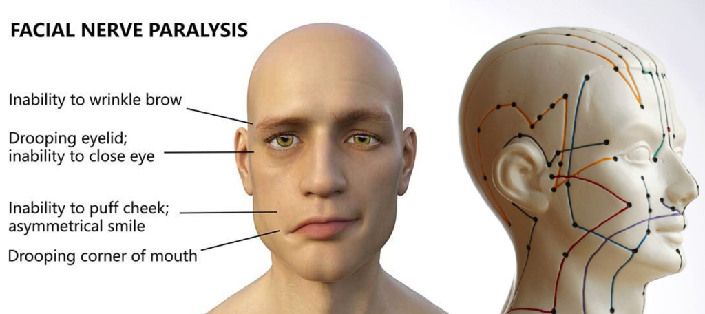 terapi akupunktur untuk mengatasi bell's palsy atau kelemahan otot wajah