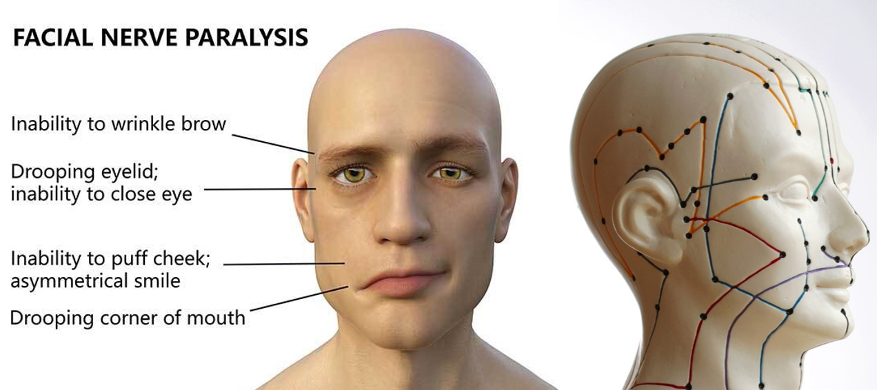 terapi akupunktur untuk mengatasi bell's palsy atau kelemahan otot wajah