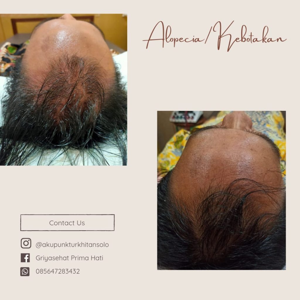 akupunktur kebotakan atau alopecia